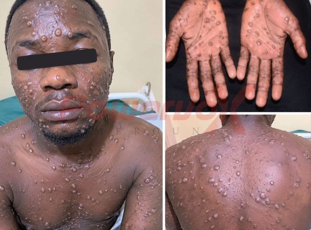 Mpox : un premier cas confirmé place Bangourain en alerte